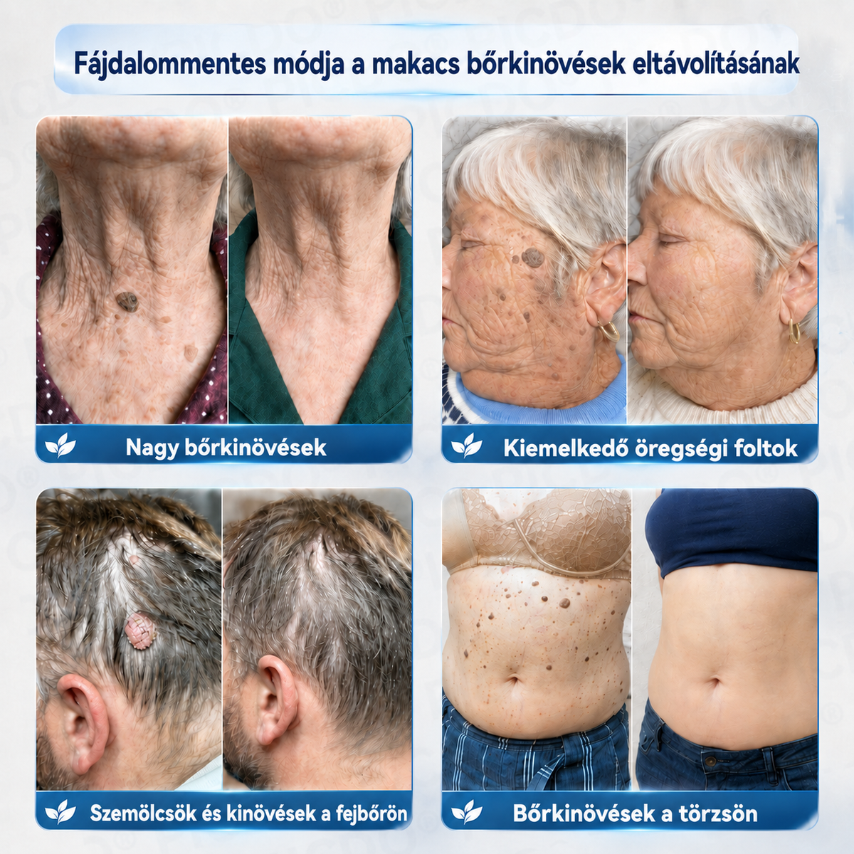 🎉✅𝐄𝐋𝐀𝐕𝐘𝐑𝐀® 𝟕 𝐧𝐚𝐩 𝐒𝐳𝐞𝐦ö𝐥𝐜𝐬- é𝐬 𝐟𝐨𝐥𝐭𝐞𝐥𝐭á𝐯𝐨𝐥í𝐭ó 𝐤𝐫é𝐦👩‍⚕️ (Zero Pain, Zero 𝐒𝐜𝐚𝐫𝐬 Formula)